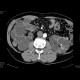 Polycystosis of kidney and liver: CT - Computed tomography